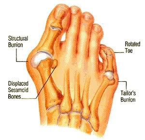 A bunion is a deformity of the foot